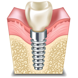 implant_icon